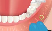 Il Dentista - Dental Implant Surgery